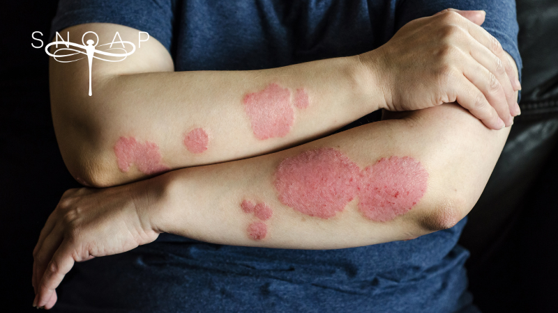 🌿 Psoriasis Awareness Day - How Nourishing Soap Helps