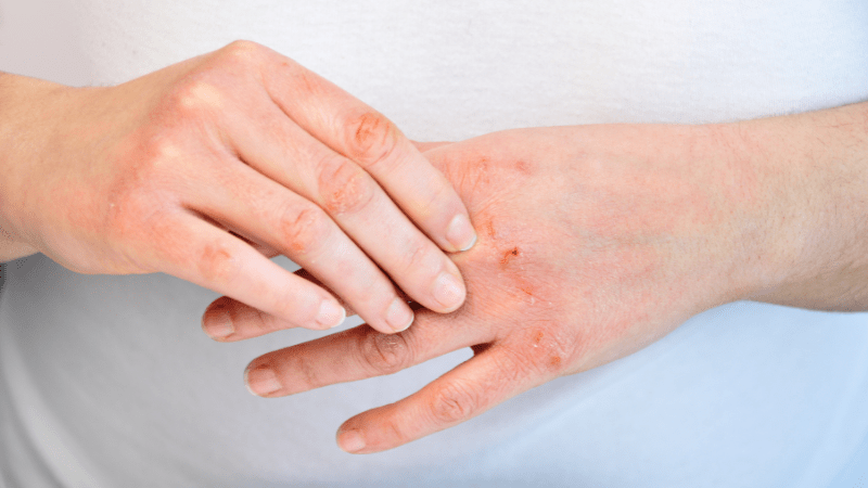 As Winter Approaches, Protect Your Hands with SNOAP