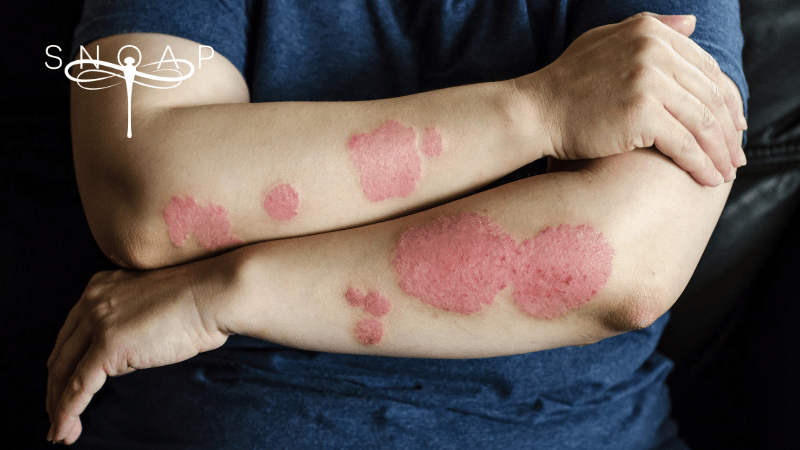 Psoriasis Awareness Day - How Nourishing Soap Helps